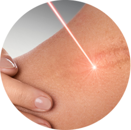 Lasertherapie